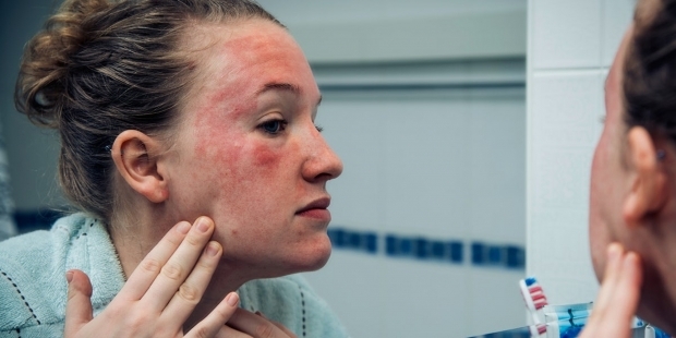 појављују се на кожи особе са хладном алергијом