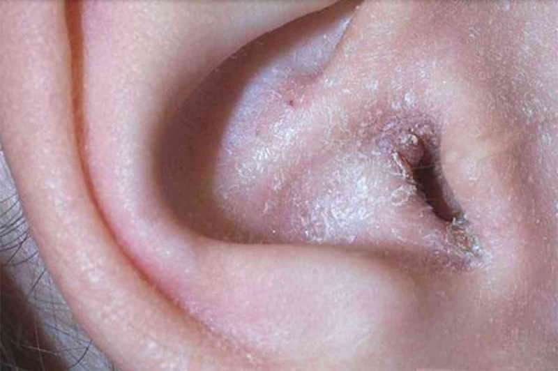 Шта узрокује пилинг иза уха и како пролази? Дефинитивно решење за екцем иза уха ...