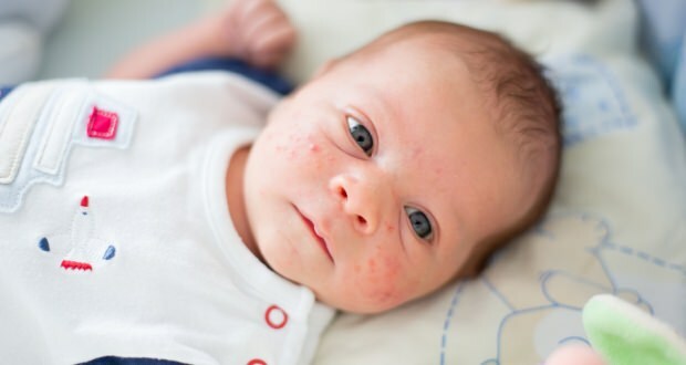Како акне прелазе на бебино лице? Методе сушења против акни (Милиа)