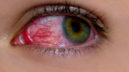 Шта изазива алергију очију? Који су симптоми очне алергије? Шта је добро за очне алергије? 