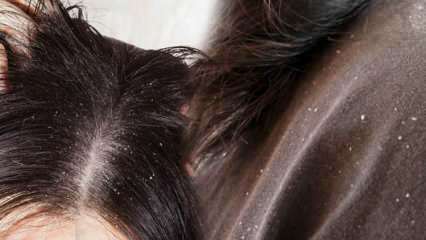 Како пролази перут и шта је добро за косу против перути? 5 најбржих и најефикаснијих метода за уклањање перути