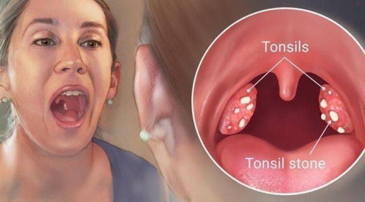 тонзилитис се назива отицање крајника