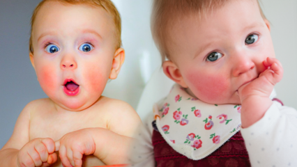 Пажња код беба са црвеним образима! Синдром сломљеног образа и његови симптоми