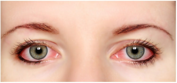 Да ли маскара и еиелинер имају алергију на очима?