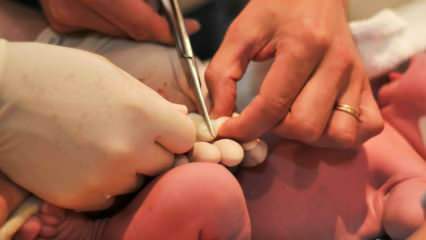 Када се бебама пререзује пупчана врпца? Предности касног сечења пупчане врпце