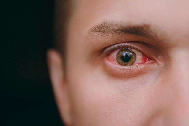 симптоми коронавируса, залијевање очију, крварење и свраб