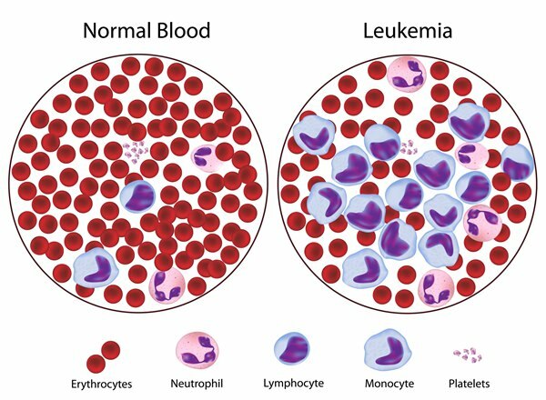 шта је леукемија