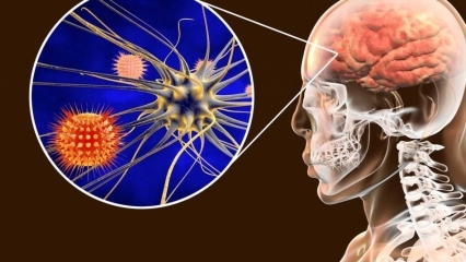Шта је менингитис и који су симптоми? Да ли постоји лек за менингитис?