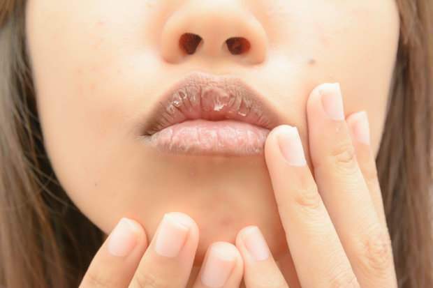 анемија узрокује суве усне