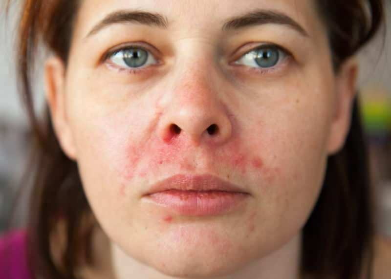 Зашто се акне појављују око усне? Како се лечи периферни дерматитис?