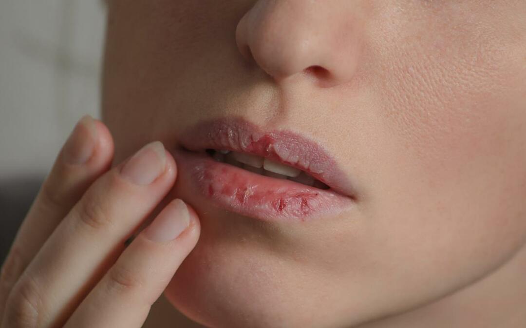 Шта узрокује тамне усне? Како се лечи потамњење или модрице на уснама?