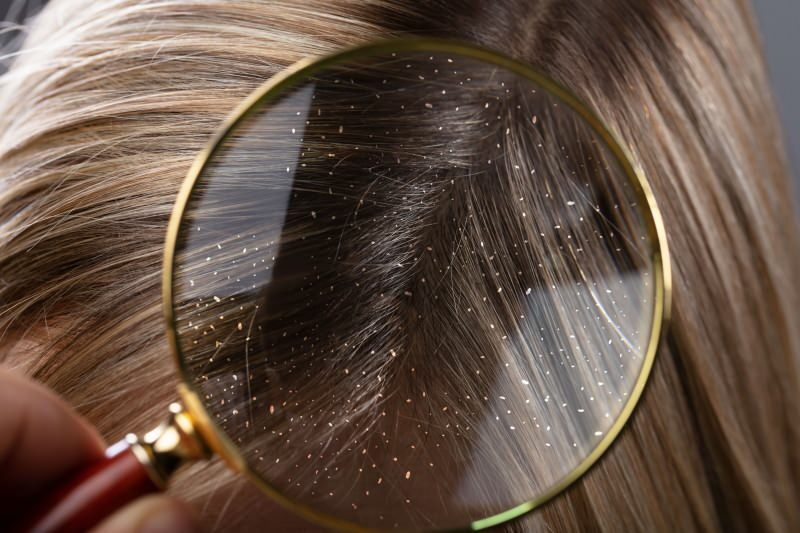 Како пролази перут и шта је добро за косу против перути? 5 најбржих и најефикаснијих лекова против перути
