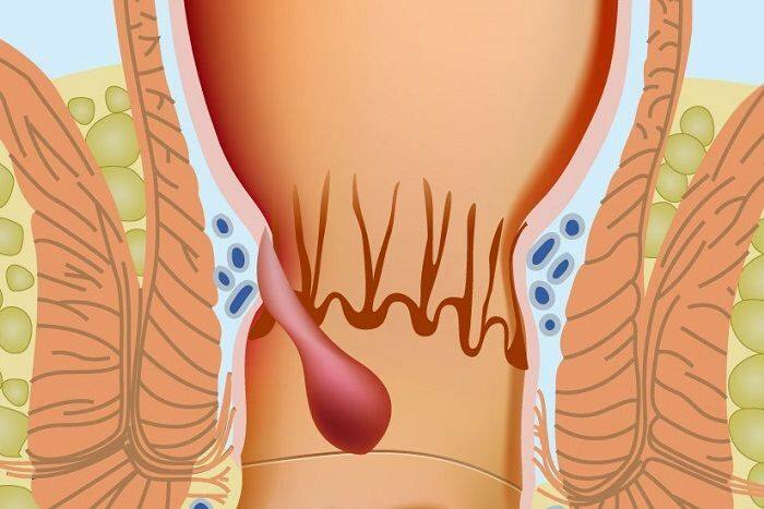 Коронавирус је повећао стопу хемороида! Који су симптоми хемороида и да ли постоји неки третман?