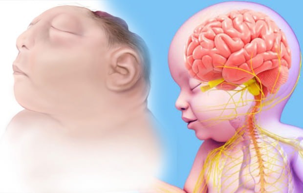 Да ли живи беба Аненцефалија? Аненцефална дијагноза
