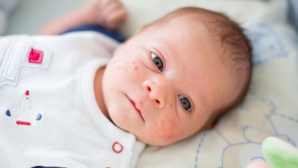 Како приштићи прелазе на бебино лице? Методе сушења против акни (Милиа)