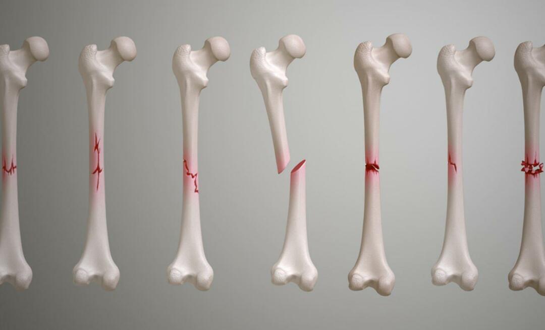 Шта је кључна кост? Колико времена је потребно да зарасте прелом кључне кости?