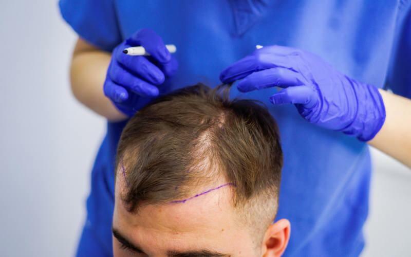 Да ли је дозвољено трансплантацију косе у лечењу губитка косе? Шта је протетска коса? Да ли протетска коса омета гхусл?
