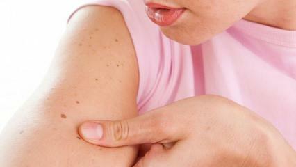 Шта је рак коже (коже) и који су његови симптоми? Начини разумевања рака коже