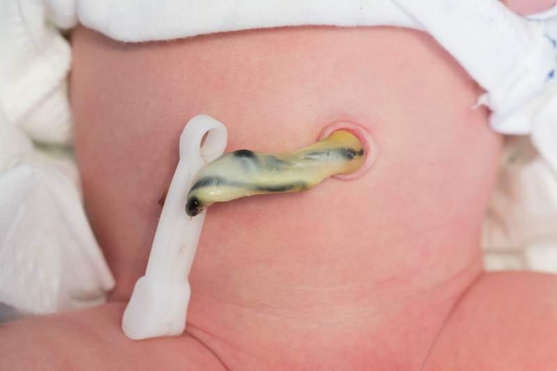 Када се бебама пререзује пупчана врпца? Предности касног сечења пупчане врпце