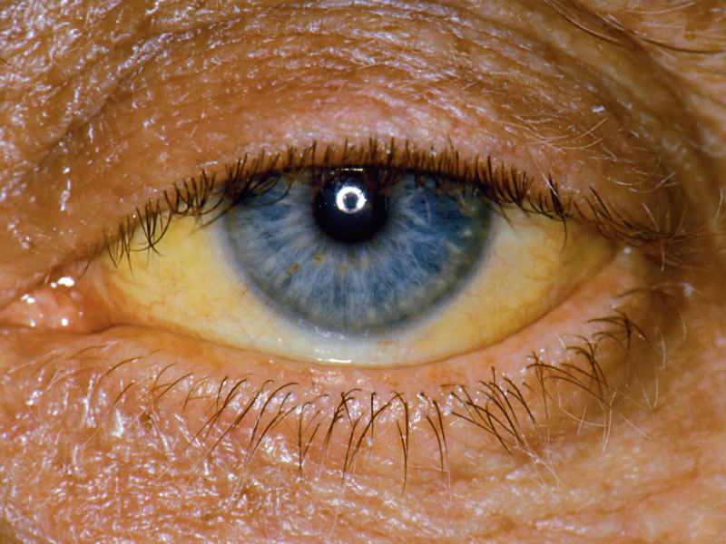 висина на нивоу билирубина узрокује жуту боју очију и коже