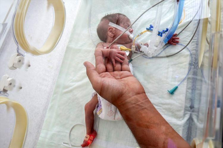 „Чудо беба“ је успела да преживи операцију