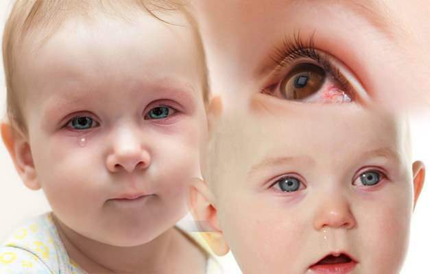 Зашто се бебиним очима даје крв? Како пролази крварење из ока код новорођене бебе?