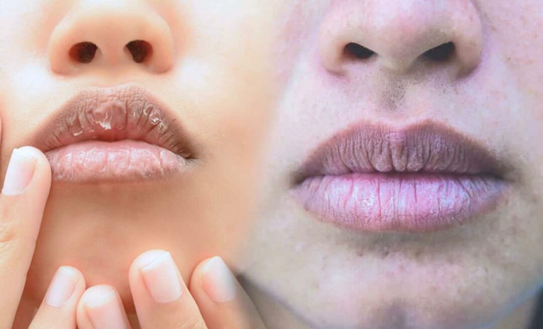 Шта узрокује тамне усне? Како се лечи потамњење или модрице на уснама?