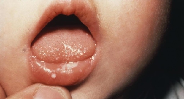 Како боли уста код беба