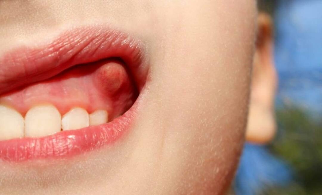 Зашто долази до апсцеса зуба и који су симптоми? Зубни апсцес, како се лечи?