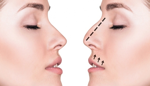 Како се ради операција носа? У којим се случајевима обавља ринопластична операција?
