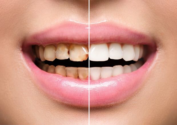 Као резултат нездраве исхране, дешава се и уклањање боје зуба и губитак зуба