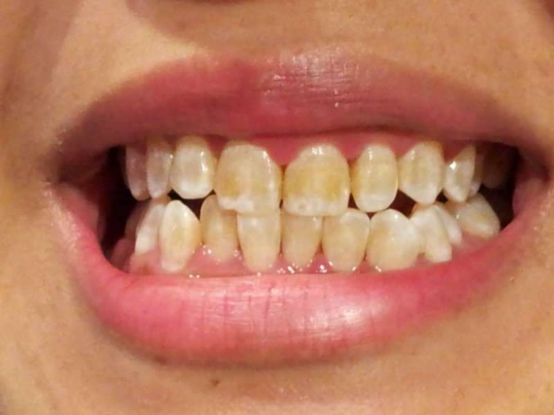 слика зуба којој зуби почињу потамнити