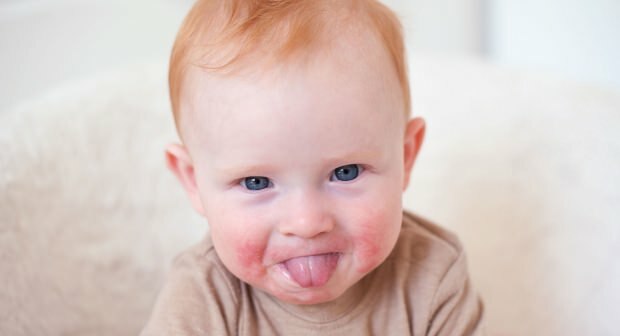 Пажња код беба са црвеним образима! Синдром сломљеног образа и његови симптоми