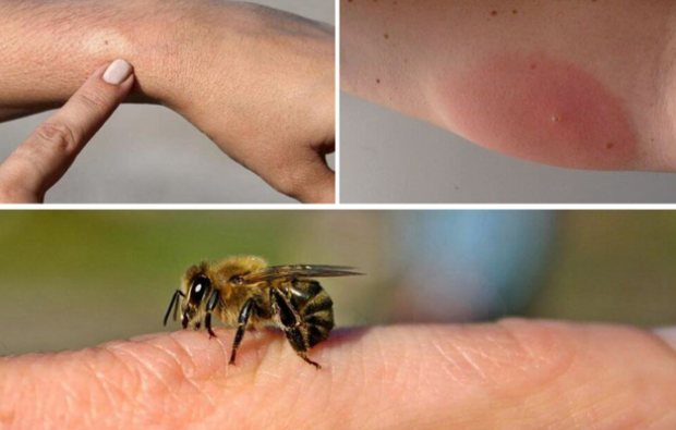 симптоми алергије на пчеле