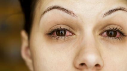 Шта је коњуктивитис (очни грип) и који су његови симптоми? Како се преноси коњуктивитис?