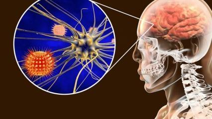Шта је менингитис и који су његови симптоми? Да ли постоји третман за менингитис?