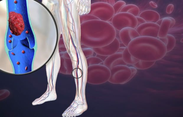 смањена циркулација крви у венама ногу изазива бол